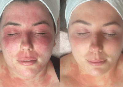 Before and after skin treatment - Cosmetic Clinic | The Mayfield Clinic by Dr. Nestor
